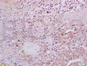 复发ALL患者但愿接受CRA-T细胞医治