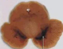 正常人：正常黑质