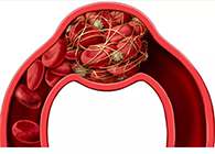 令人“闻风丧胆”的脑卒中发现医治新机造！
