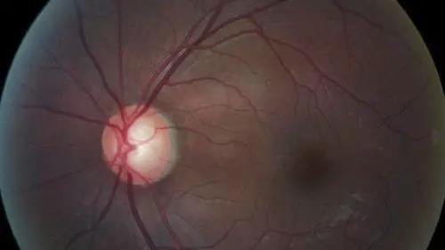 青光眼的克星来袭，助力患者远离视力的“窃贼”